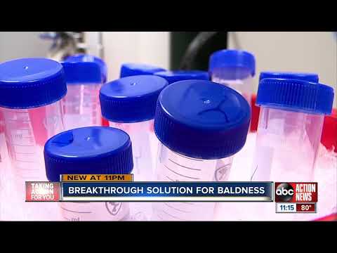 California lab creating &#039;cure&#039; for baldness using cell cloning process