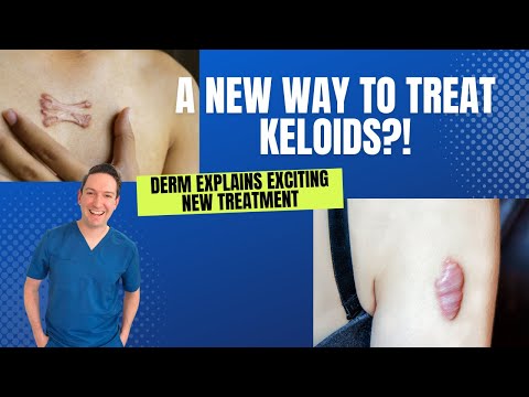 A new treatment for Keloids?! A dermatologist explains how dupixent (dupilumab) may help!