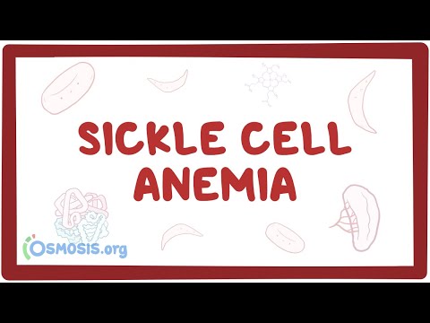 Sickle cell anemia - causes, symptoms, diagnosis, treatment &amp; pathology