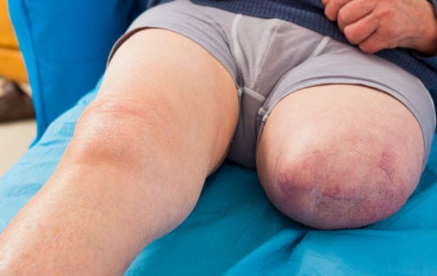A person with an amputation