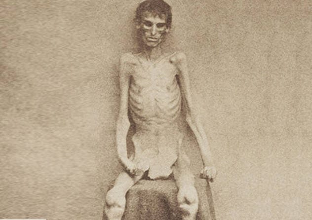 Emaciated Civil War Soldier