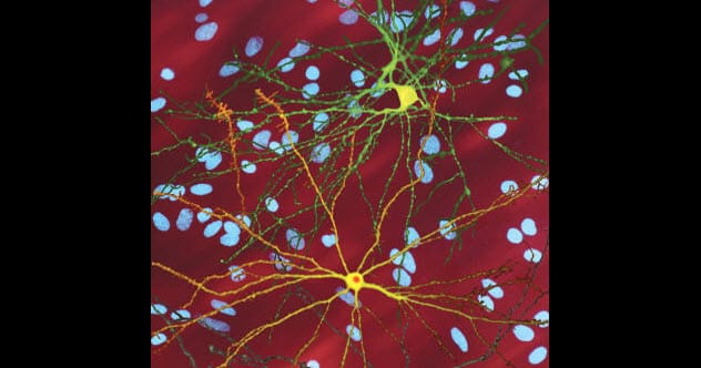 Illustration of nerve cells affected by Huntington's disease