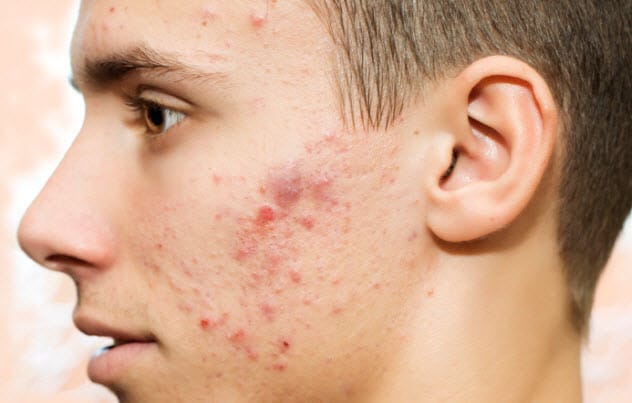 Close-up of acne on human skin