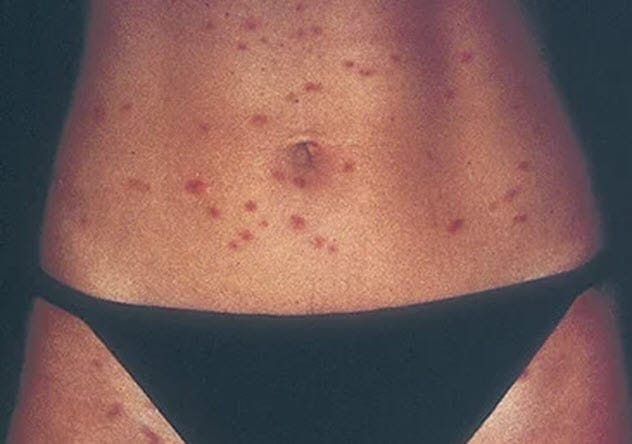 Cercarial Dermatitis