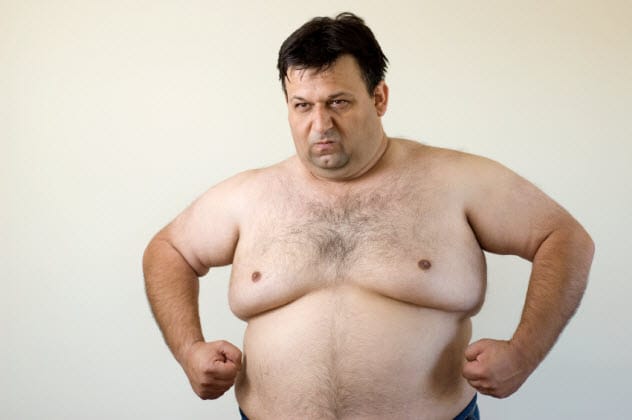 Man with visible breast tissue, known as gynecomastia