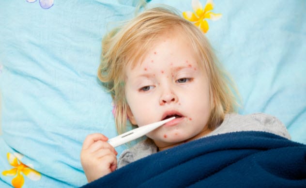 Child with measles rash on their face