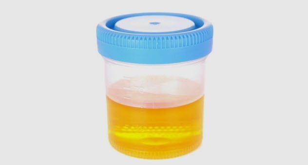 Scientific beaker containing yellow liquid, representing urine