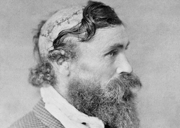 Robert McGee, a survivor of a live scalping, displaying his injuries