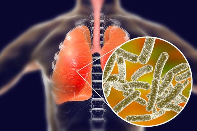 Legionnaires’ Disease