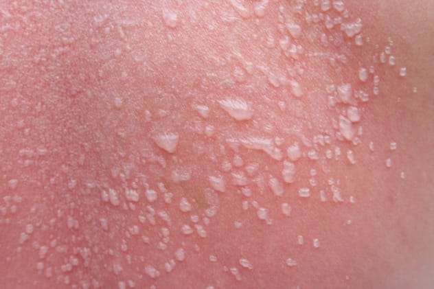 Image depicting blistered skin as a result of radiation overexposure