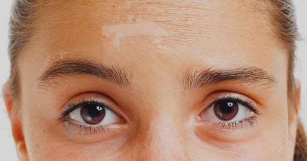 Image showing severe skin burns, indicative of radiation overexposure