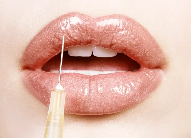 Close-up of lips, potentially illustrating the negative effects of poorly administered lip fillers