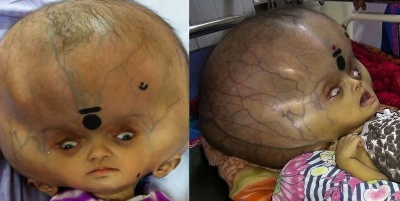 largest human head