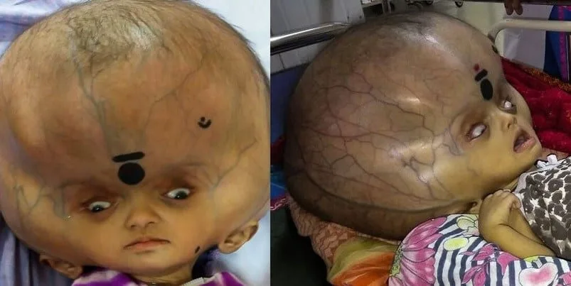 largest human head