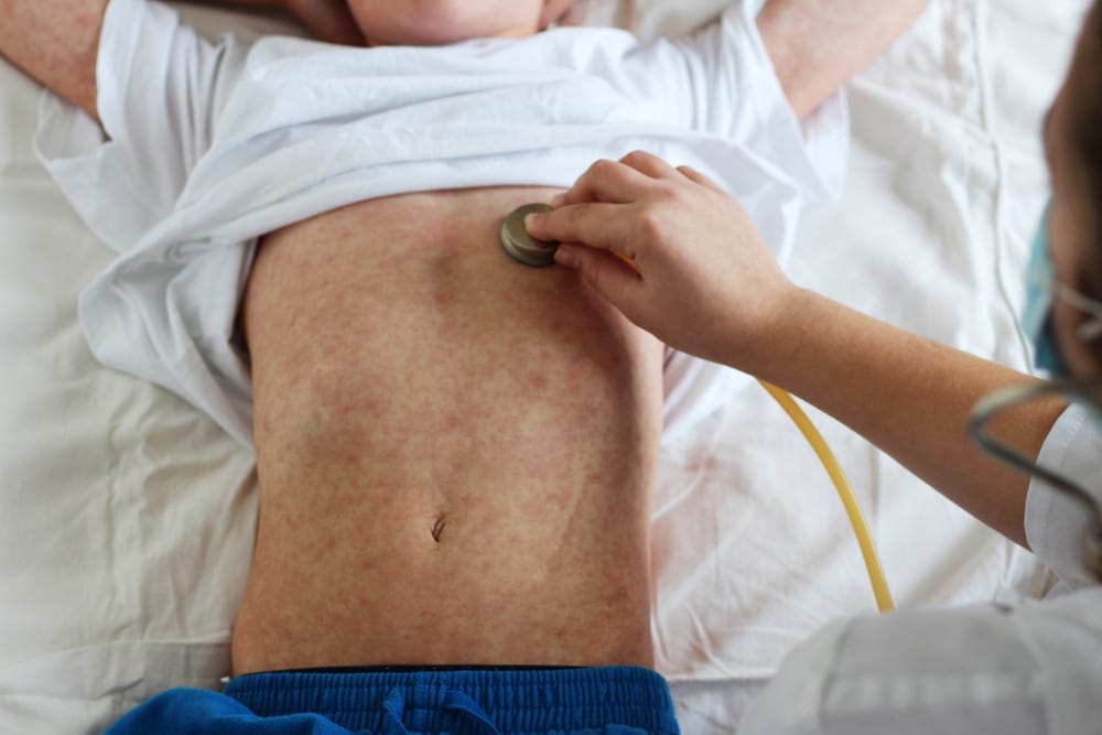 Measles rash on a child's face