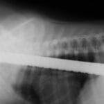 Top 10 Craziest Objects Removed From the Human Body