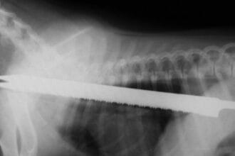 Top 10 Craziest Objects Removed From the Human Body