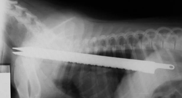 Top 10 Craziest Objects Removed From the Human Body