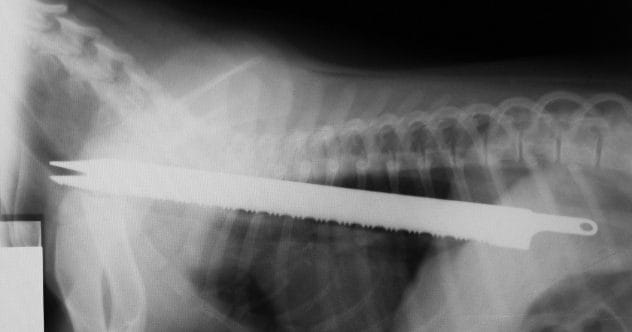 Top 10 Craziest Objects Removed From the Human Body