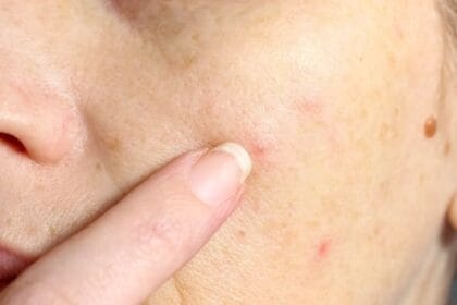 Gross Facts: 10 Things You Didn't Know About Your Skin