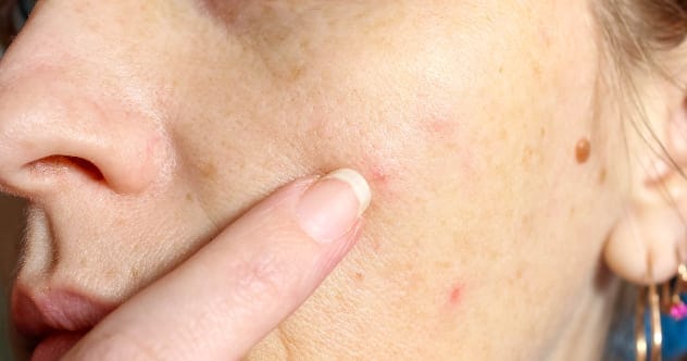 Gross Facts: 10 Things You Didn't Know About Your Skin