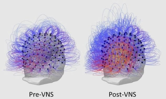 Illustration of vagus nerve stimulation treatment